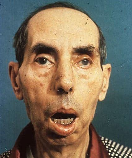 Myotonic dystrophy – learn all about it in 5 minutes – Costamedic