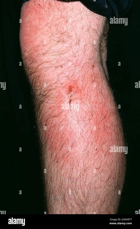 Infected bee sting. Infected, weeping wound on the leg of a 38-year-old ...