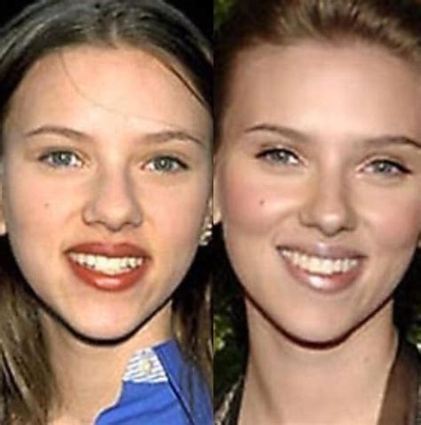 Scarlett Johansson Nose Job