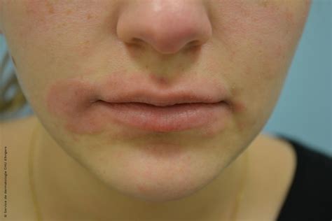 Eczema Around Corners Of Mouth at Beulah Insley blog