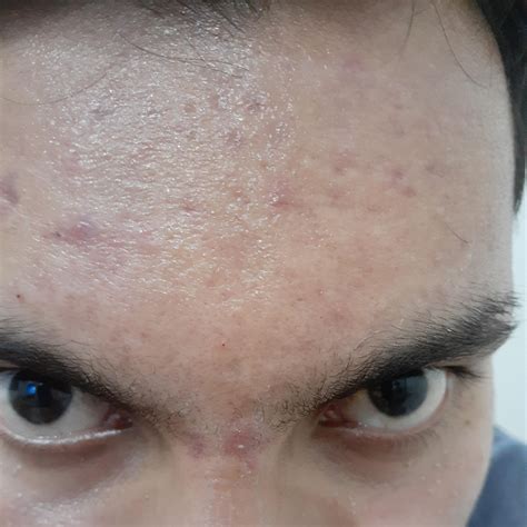 What should I do for these forehead acne scars? : r/Skincare_Addiction