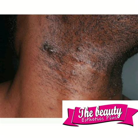 pseudofoliculitis de barba  pelo encarnado en la barba es una