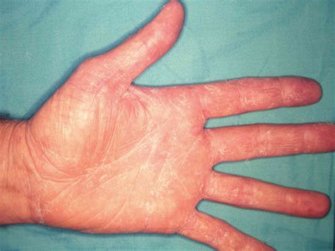 Hand Rash: 12 Possible Causes and Treatment Options