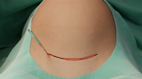 C-section: indications, preparation, steps, postoperative management