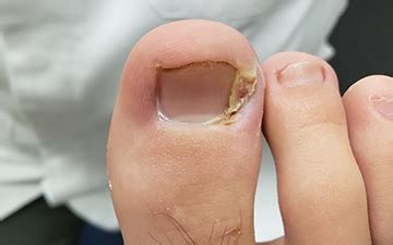 Ingrown Toenail | Medical Foot Solutions