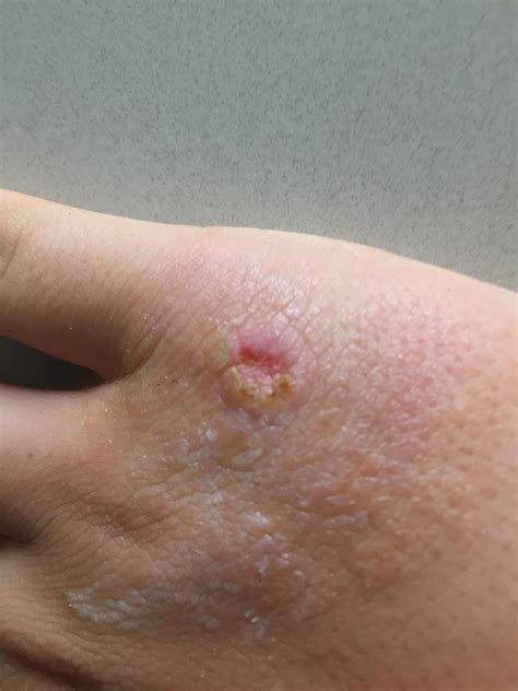 Treated wart with saylic acid for a while, was pretty much done when