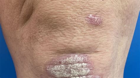 Psoriasis o artritis psoriásica, un abordaje integral más allá de la piel