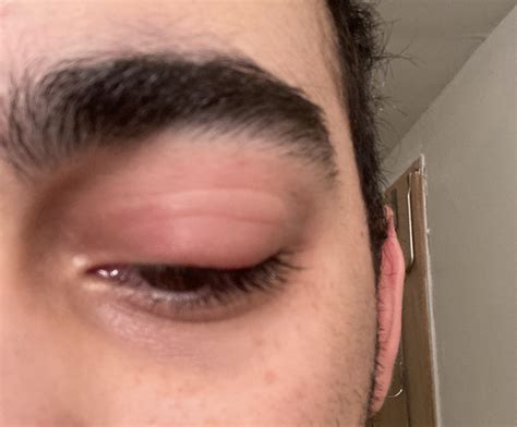 how to reduce eye swelling 2