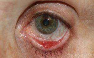 Moran CORE | What are the differences between a stye, a chalazion, an ...