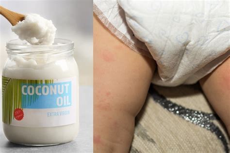 Is Coconut Oil Good For a Yeast Diaper Rash?