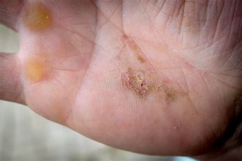 hand  wounds  scars stock image image  open