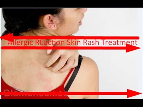 Allergic Reaction Skin Rash Treatment 2016 - YouTube