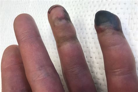 everest frostbite fingers