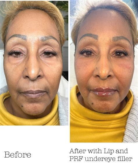 How to fix dark circles and undereye hollows??