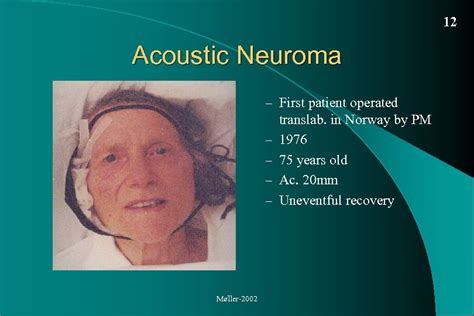 Acoustic Neuroma Vestibular Schwannoma Diagnosis and treatment Per