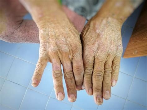Systemic Sclerosis Overview - Rare Disease Advisor
