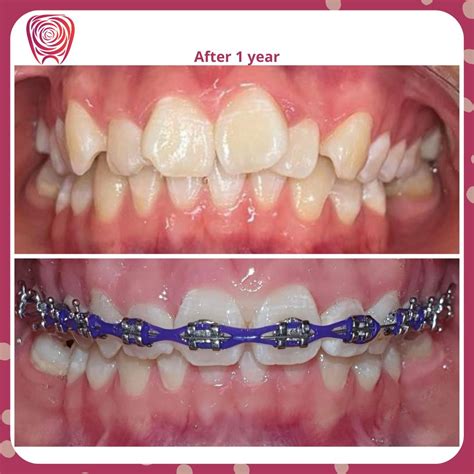 result – Cuticul Dental Clinic
