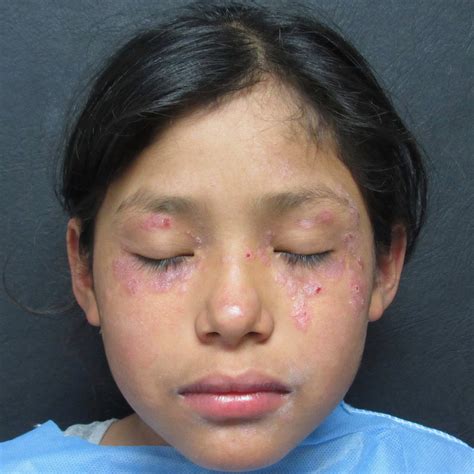 actinic prurigo dr aye min htoo