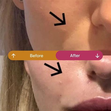 nose  mouth lines  botox  soften smile lines