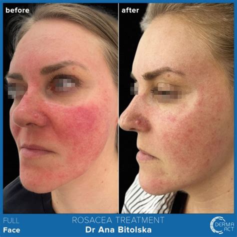 Розацея - причини, диагностика и лечение | Derma-Act