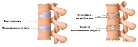 Мазь от хондроза: перечень эффективных препаратов