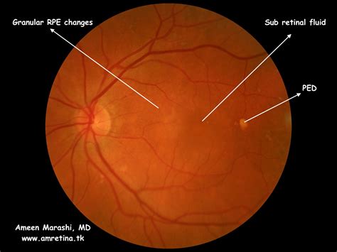 Chronic Central Serous Chorioretinopathy fundus image, OCT and FFA in a ...