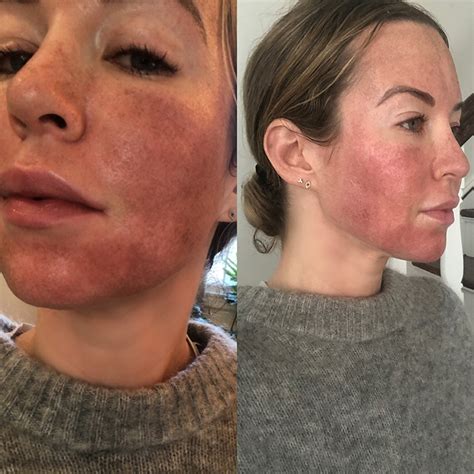profractional laser  fraxel le relissage fractionne par laser lfmp