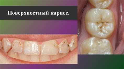 Кариес зубов - презентация онлайн