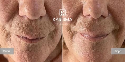 KARISMA - Softfiller biorestitutivo | Rh Collagen