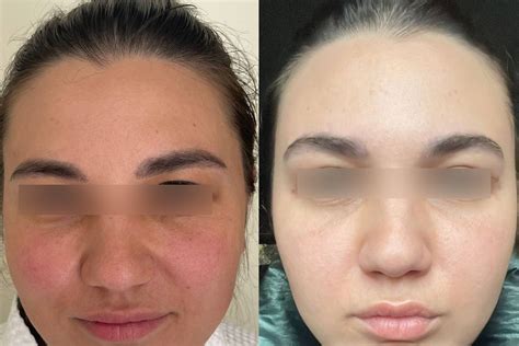 Эндоскопическая подтяжка лба и бровей в VIP Clinic. Цены на лифтинг ...