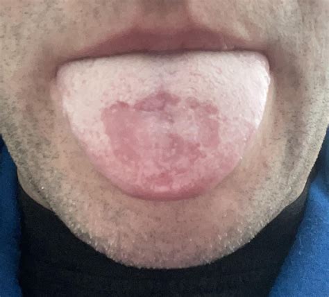 Is this Geographic Tongue or Thrush or both? : r/askdentists