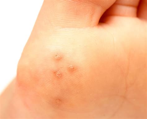 Causes Of Hand Warts