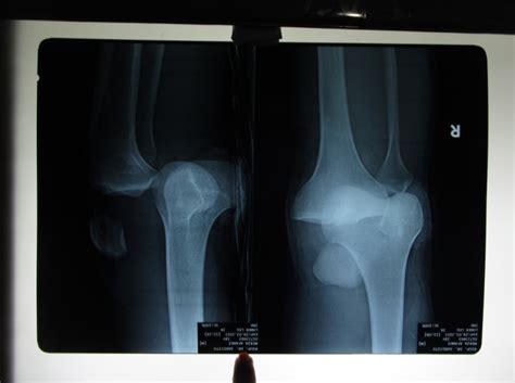 orthopaedi knowledges dislocation   knee joint