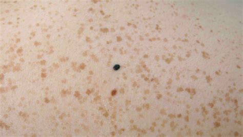 Chapter 4 - Skin Cancer 909