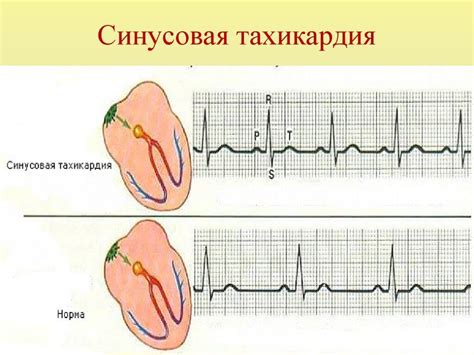 Синусовая тахикардия. синусовая брадикардия