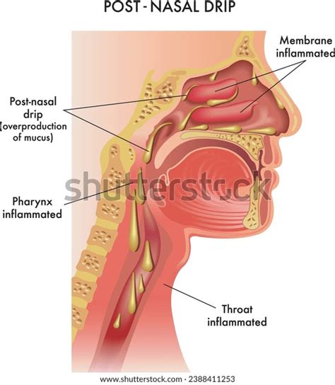 Medical Illustration Symptoms Post-nasal Drip Annotations Stock Vector (Royalty Free) 2388411253 ...