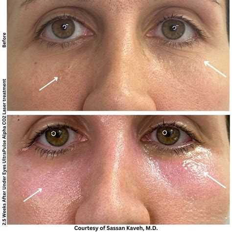 laser resurfacing  eyes    surgical fix  fine