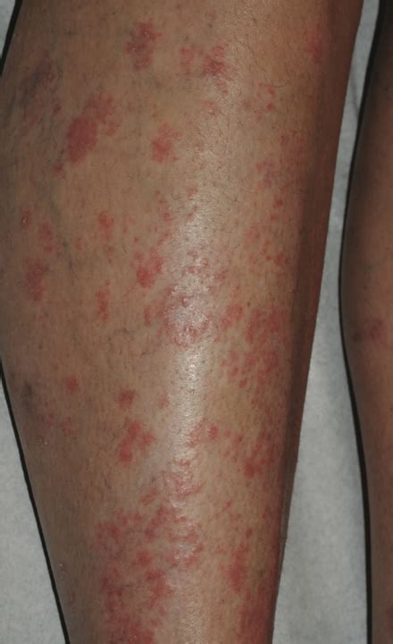 What Is Causing This Psoriasis Exacerbation? | Consultant360