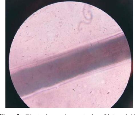 Figure 2 from KERION TYPE OF TINEA CAPITIS TREATED WITH DOUBLE PULSE ...