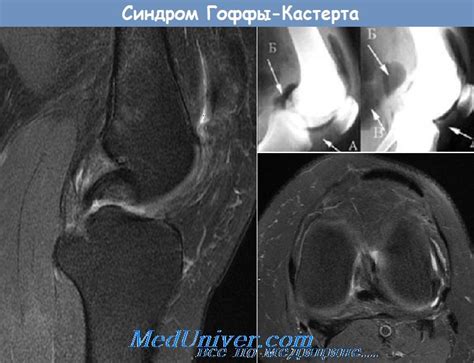 Синдром Гоффы-Кастерта (Hoffa-Kastert) - синонимы, авторы, клиника