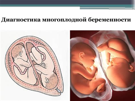 Многоплодная беременность при экстракорпоральном оплодотворении ...