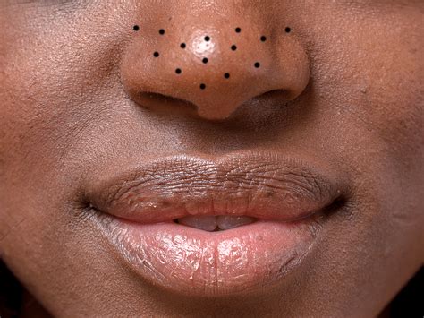Unbelievable Blackhead Removal 2024: A Comprehensive Overview - h5r8v97