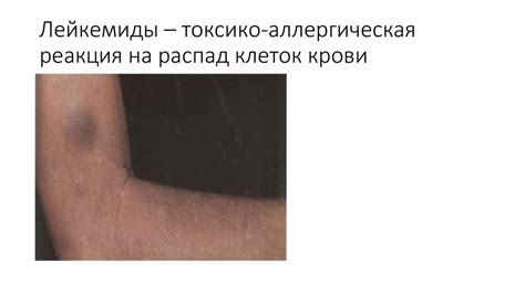 Лимфопролиферативный синдром - презентация онлайн