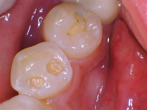Instant and Accurate Detection of Early Occlusal Caries | Dental Jay