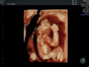 ANENCEPHALY 3D IMAGES | Looking Through a Transducer