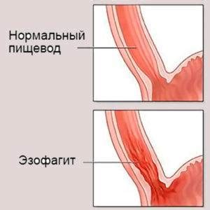 Воспаление пищевода: симптомы, причины и виды