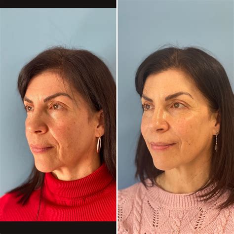 dermal filler glavellar line gainesville florida 10