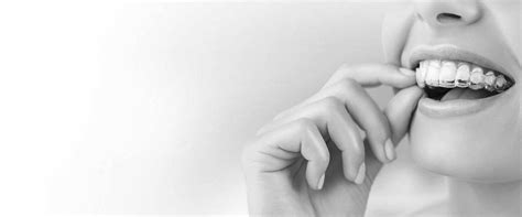 orthodontics invisalign  dental orthodontic centre