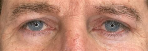 Bilateral Upper Lid Blepharoplasty - PARAG GANDHI, MD FACS