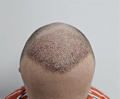 ins  outs  fue post operative care hair transplant